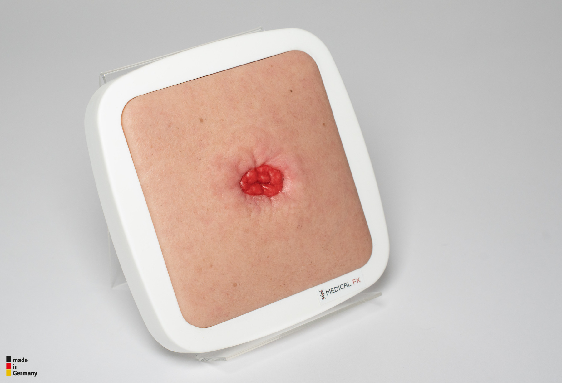 Rahmenmodell Stoma in einer Mulde – Bild 2
