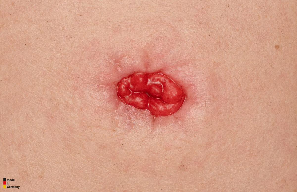 Rahmenmodell Stoma in einer Mulde