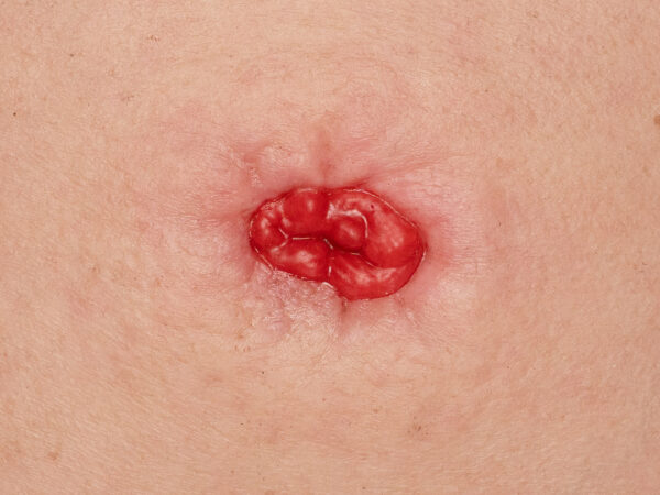 Rahmenmodell Stoma in einer Mulde – Bild 3