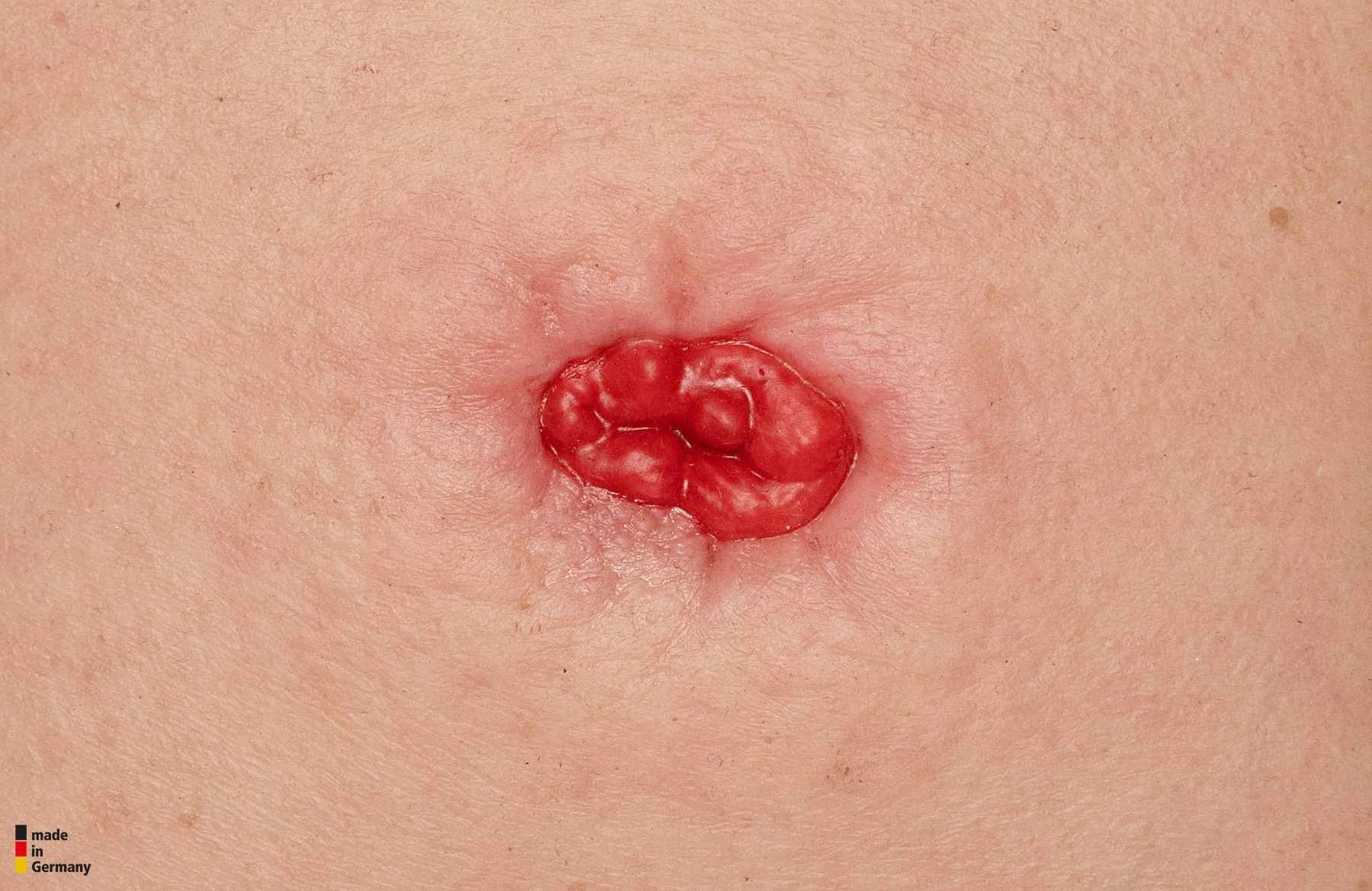 Rahmenmodell Stoma in einer Mulde – Bild 3