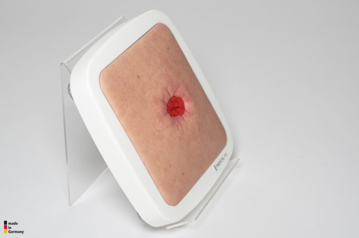 Rahmenmodell Stoma in einer Mulde