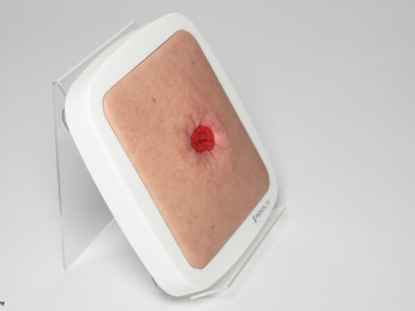 Rahmenmodell Stoma in einer Mulde – Bild 4