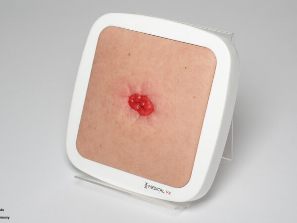 Rahmenmodell Stoma in einer Mulde – Bild 5