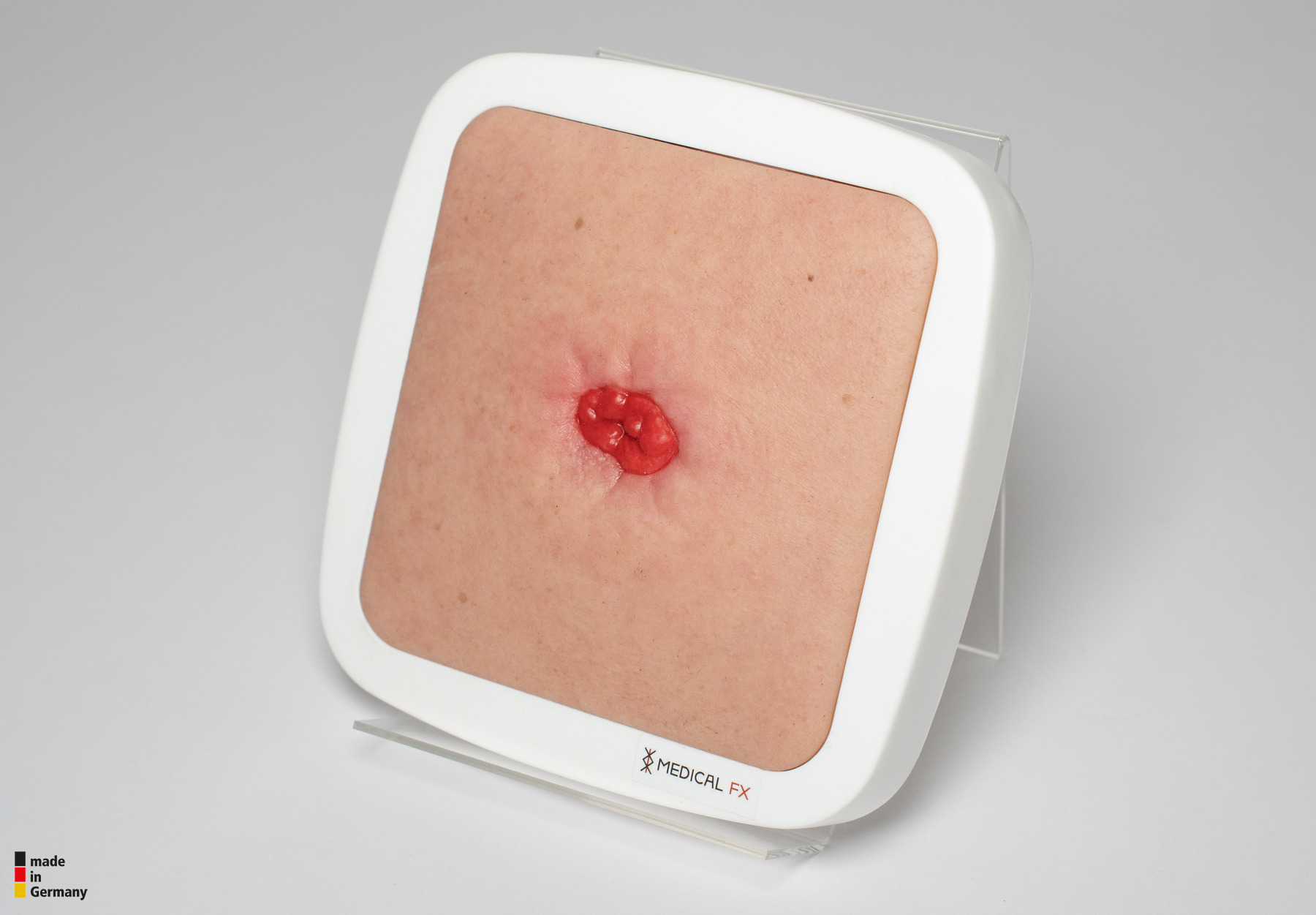 Rahmenmodell Stoma in einer Mulde – Bild 5