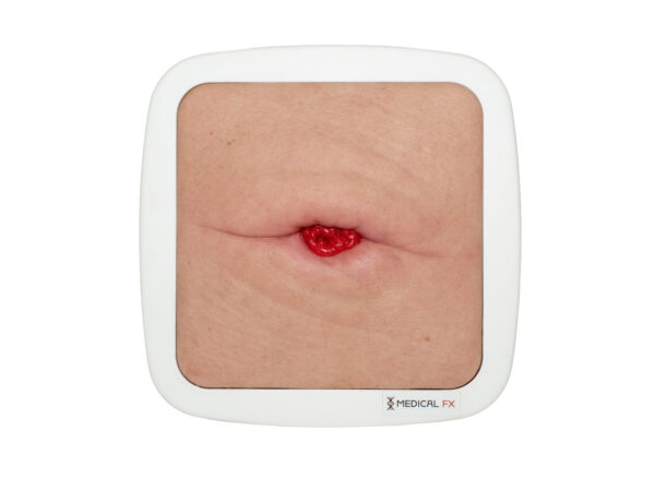 Frame Model Stoma in a Skin Fold