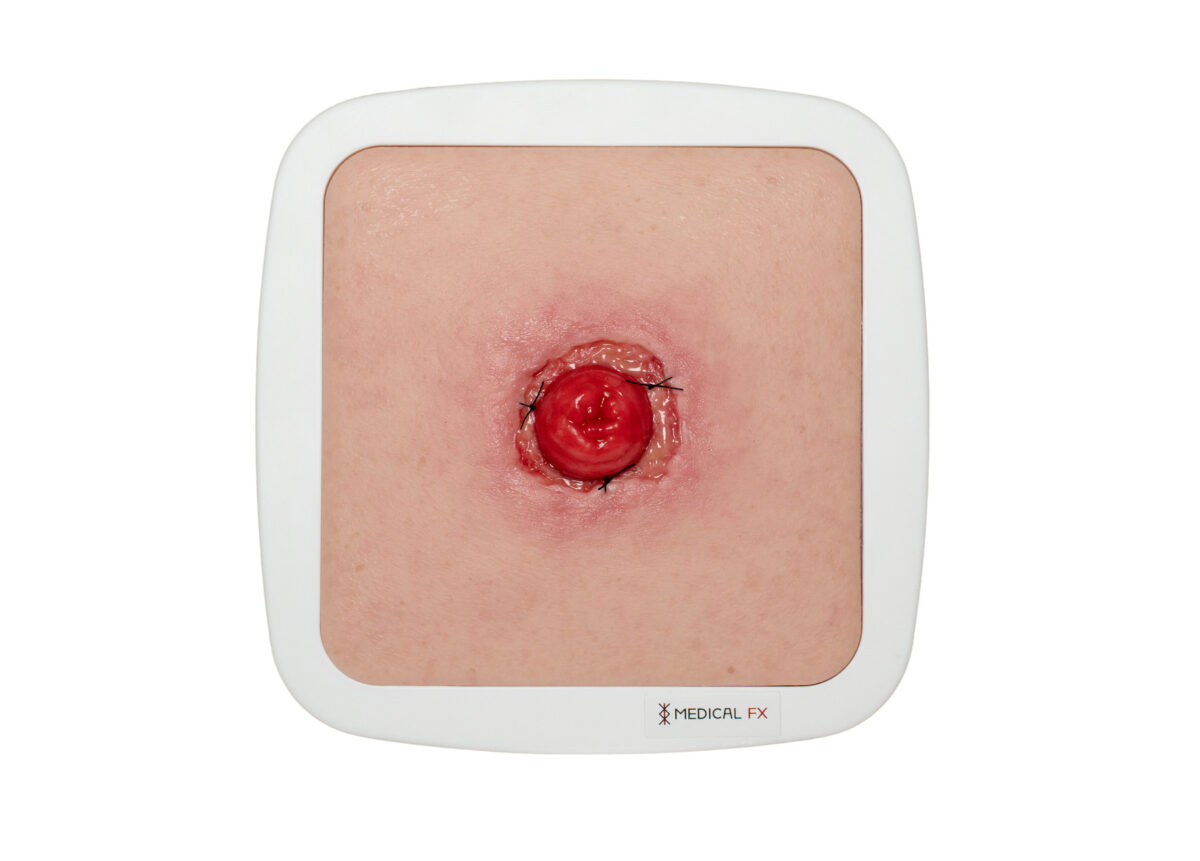 Frame Model Stomie avec déhiscence de suture