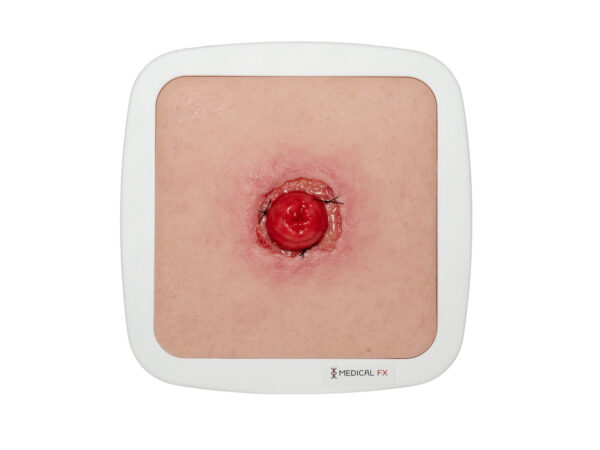 Frame Model Stomie avec déhiscence de suture - Image 1