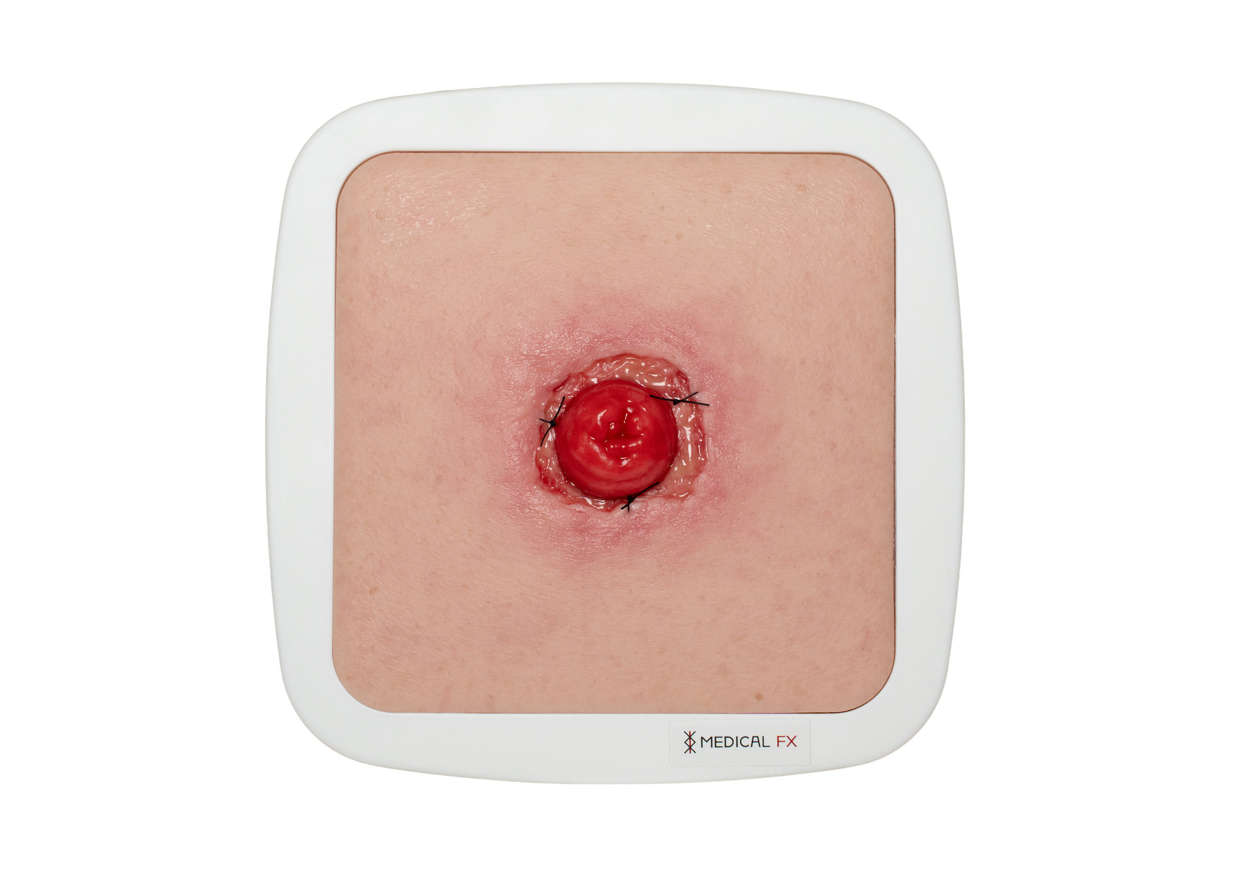 Frame Model Stomie avec déhiscence de suture - Image 1