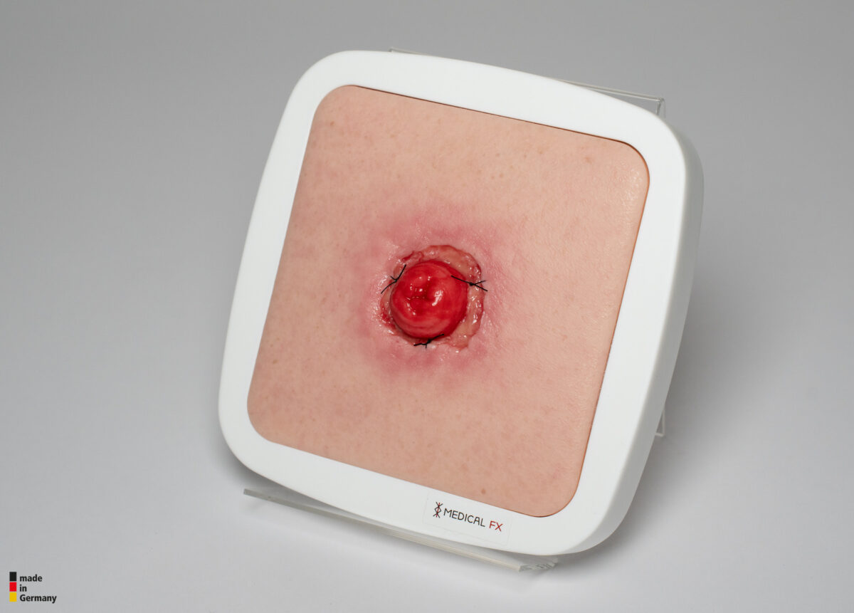 Frame Model Stomie avec déhiscence de suture