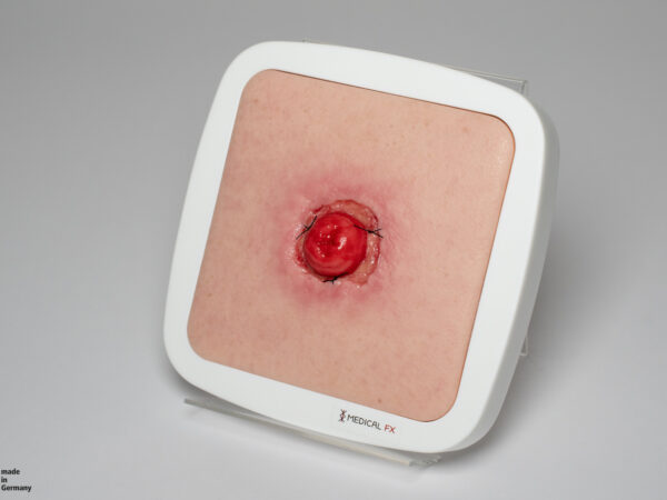 Frame Model Stomie avec déhiscence de suture - Image 3