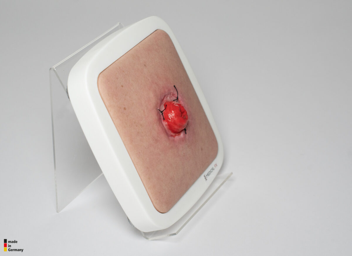 Frame Model Stomie avec déhiscence de suture