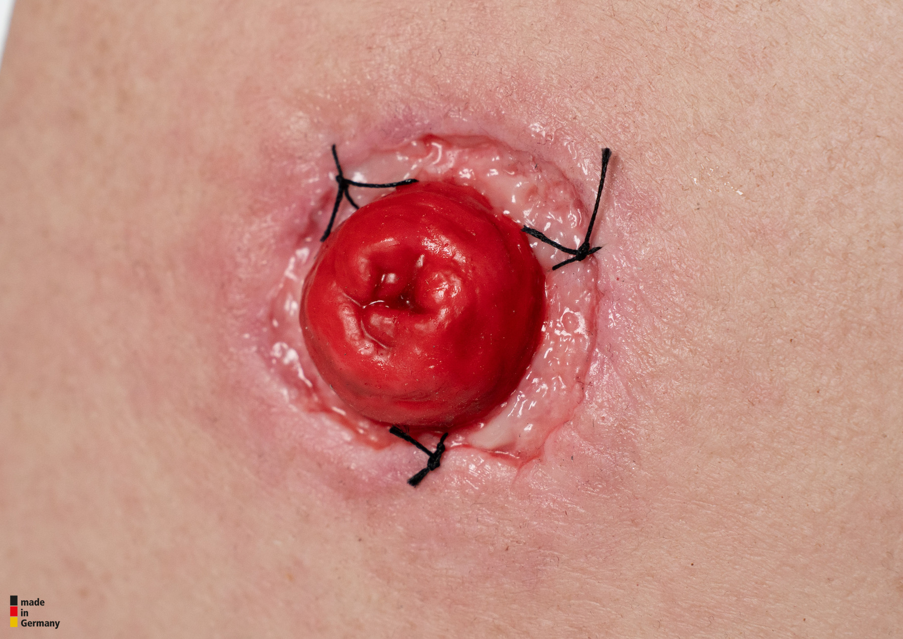 Frame Model Stomie avec déhiscence de suture - Image 2