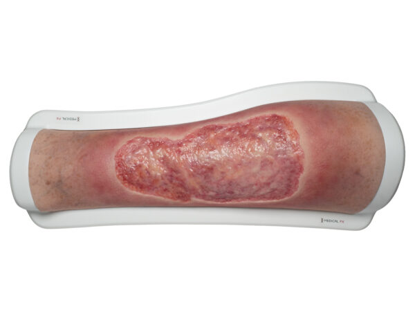 Frame Model Venous Leg Ulcer (VLU)