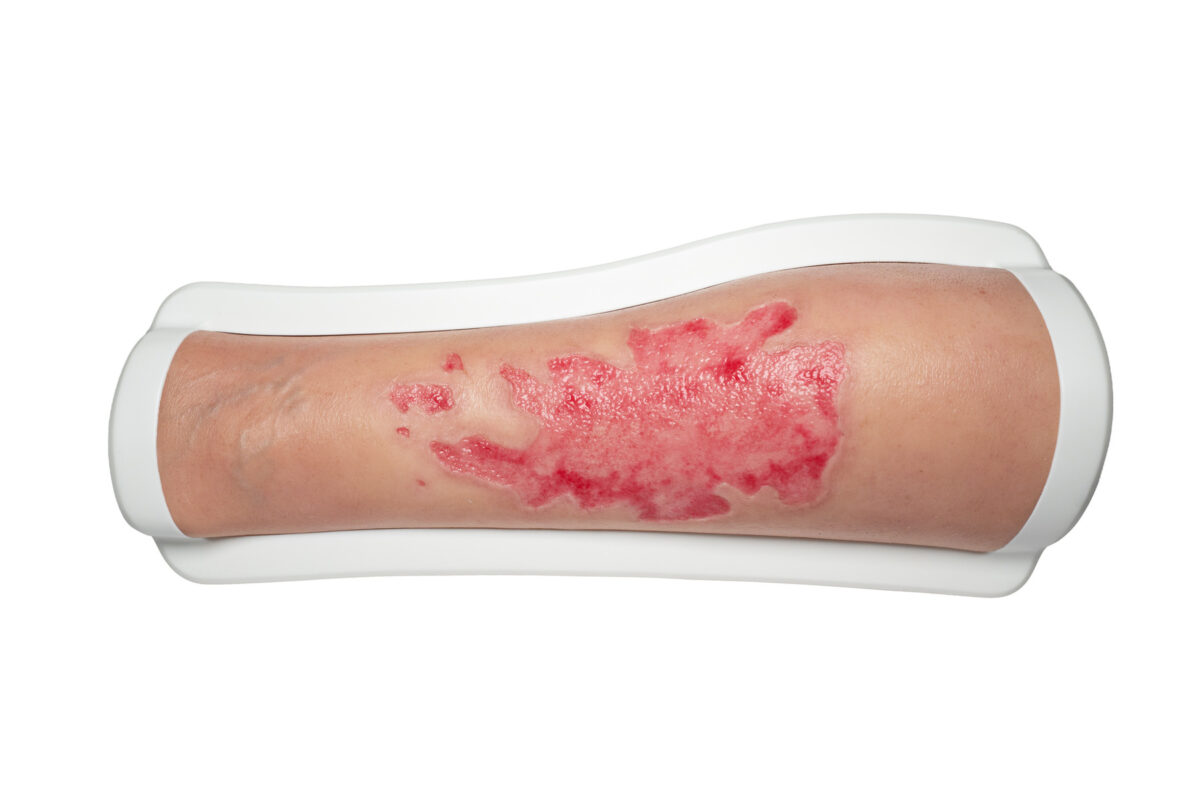 Rahmenmodell Bein mit Brandwunde Grad 3