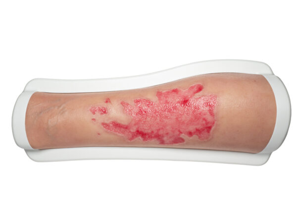 Frame Model Leg with Burn Injury Stage 3