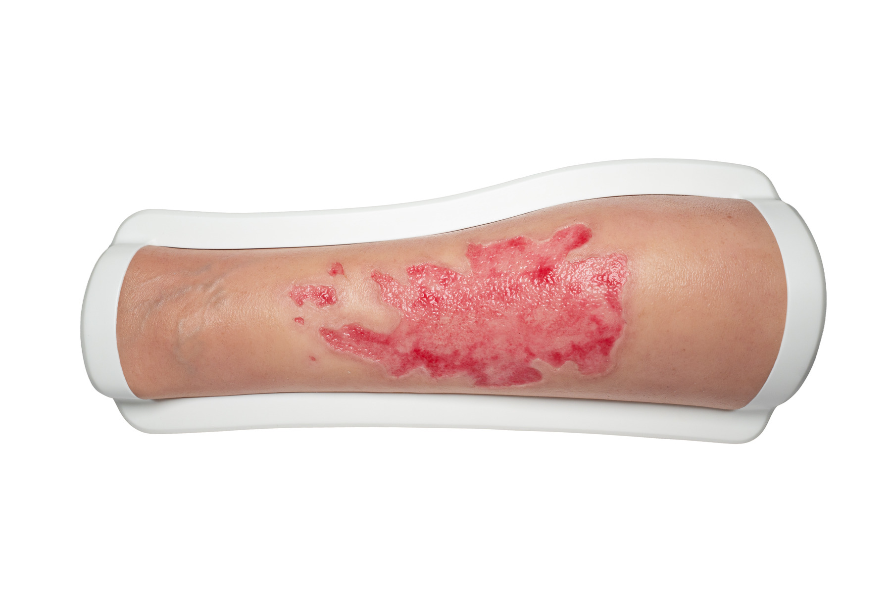 Rahmenmodell Bein mit Brandwunde Grad 3 – Bild 1