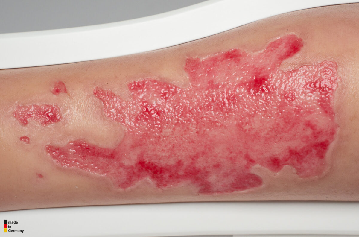 Rahmenmodell Bein mit Brandwunde Grad 3