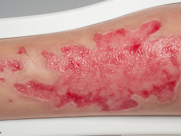 Rahmenmodell Bein mit Brandwunde Grad 3 – Bild 2