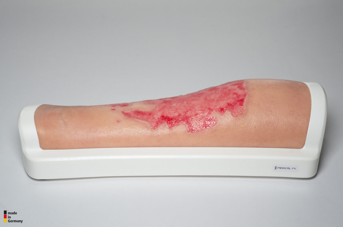 Rahmenmodell Bein mit Brandwunde Grad 3