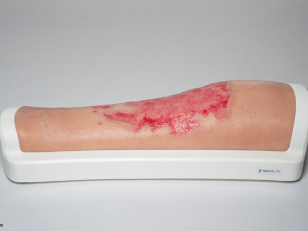 Rahmenmodell Bein mit Brandwunde Grad 3 – Bild 3