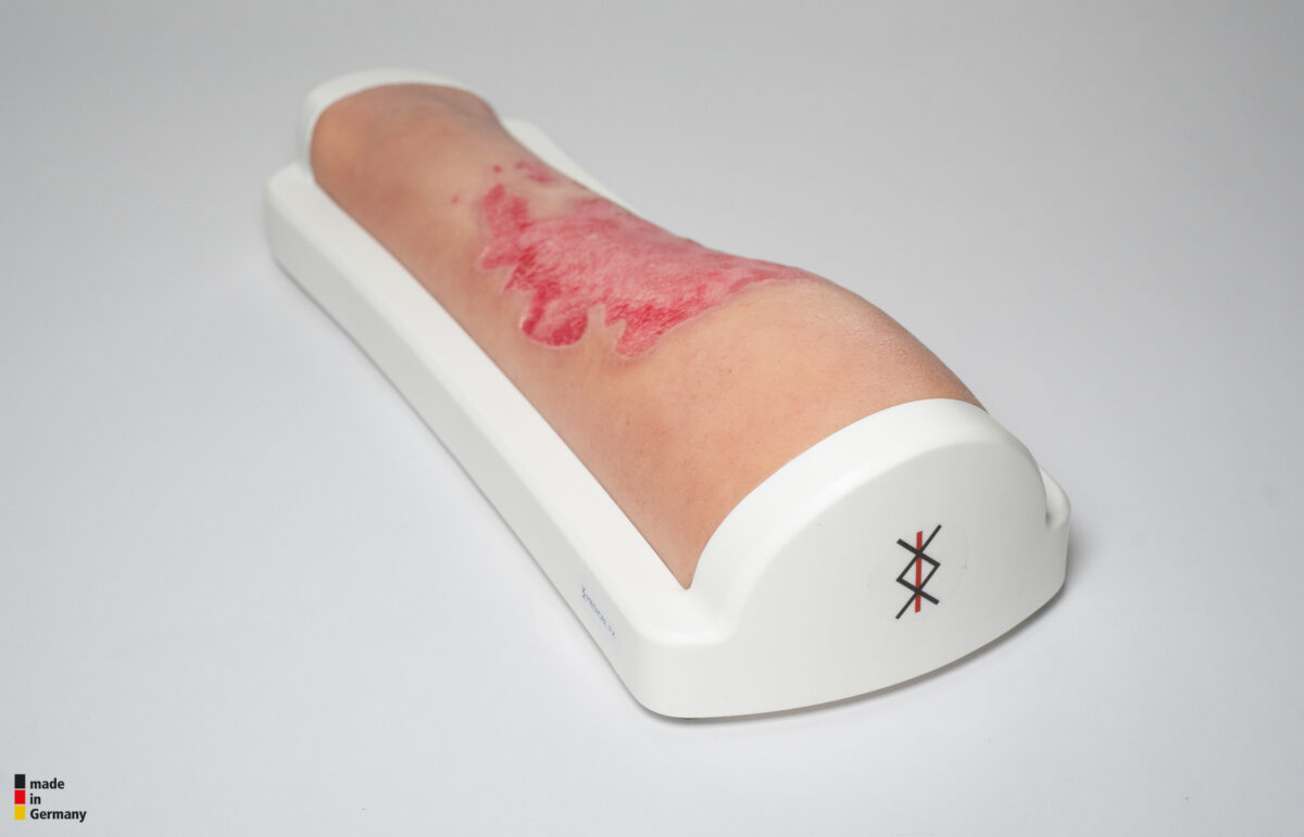 Rahmenmodell Bein mit Brandwunde Grad 3