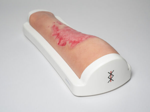 Rahmenmodell Bein mit Brandwunde Grad 3 – Bild 4