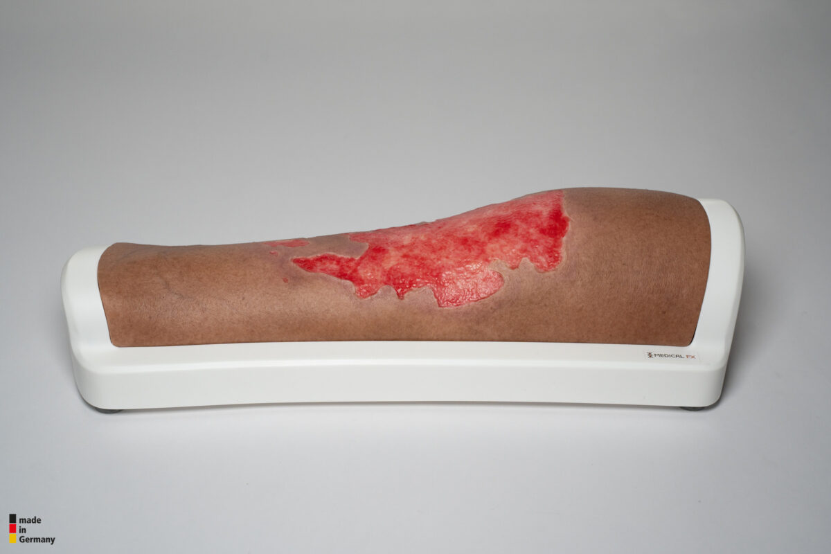 Rahmenmodell Bein mit Brandwunde Grad 3