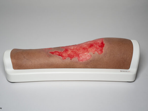 Rahmenmodell Bein mit Brandwunde Grad 3 – Bild 5