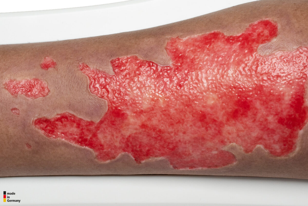 Rahmenmodell Bein mit Brandwunde Grad 3