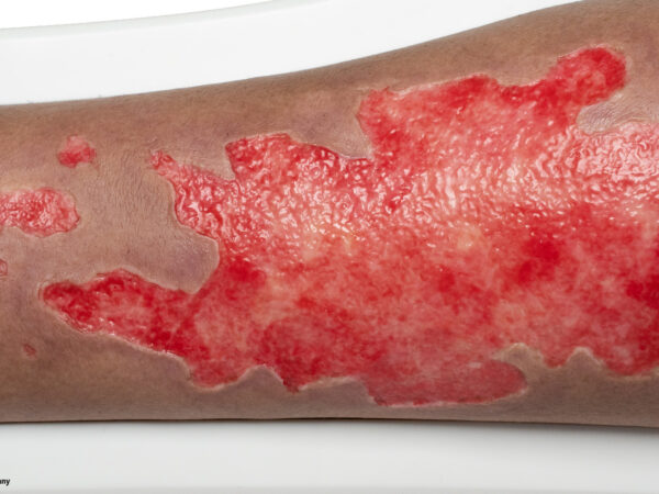 Rahmenmodell Bein mit Brandwunde Grad 3 – Bild 7