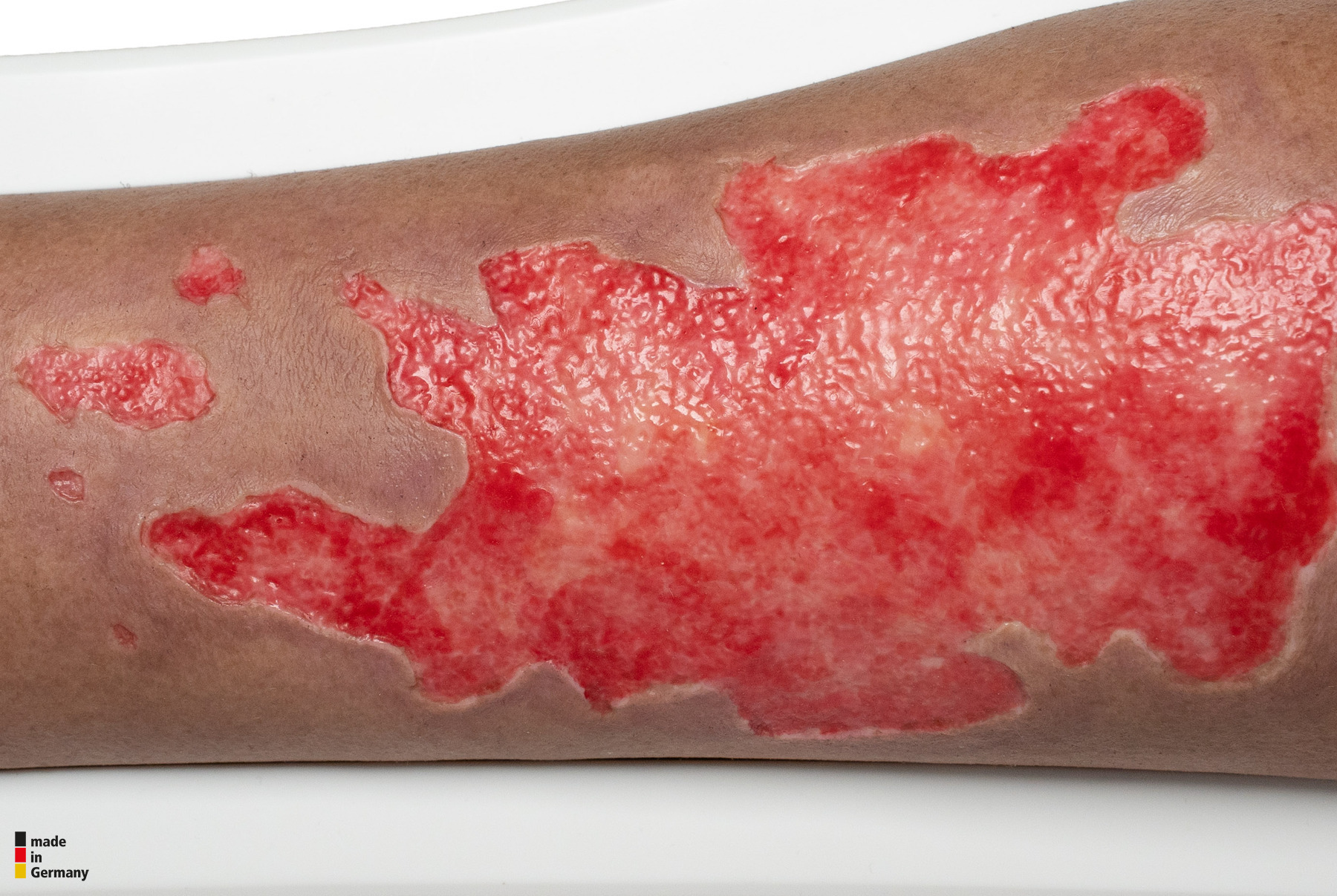 Rahmenmodell Bein mit Brandwunde Grad 3 – Bild 7