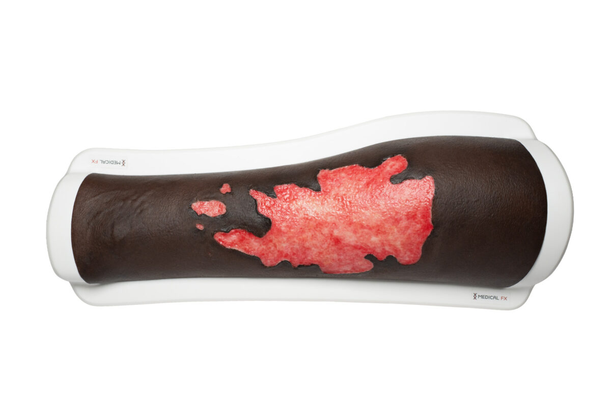 Rahmenmodell Bein mit Brandwunde Grad 3