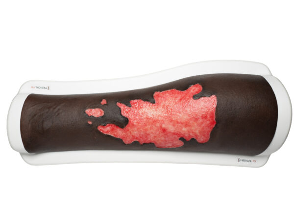 Rahmenmodell Bein mit Brandwunde Grad 3 – Bild 14