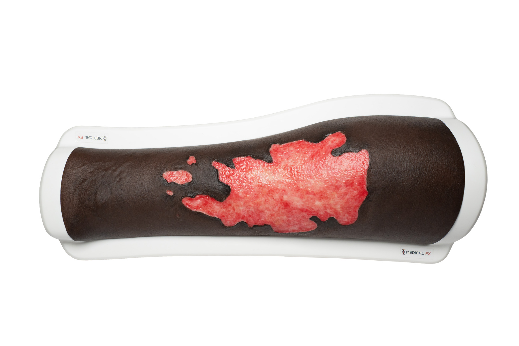 Rahmenmodell Bein mit Brandwunde Grad 3 – Bild 14