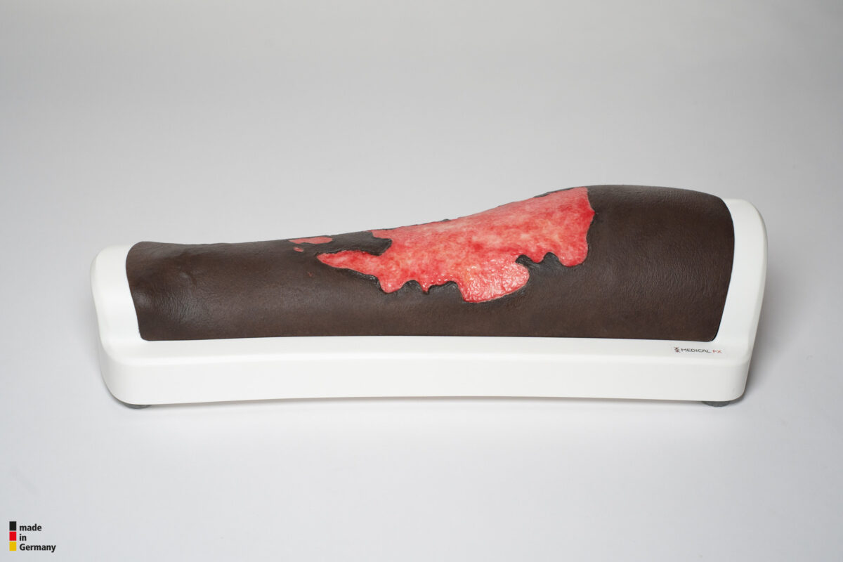 Rahmenmodell Bein mit Brandwunde Grad 3