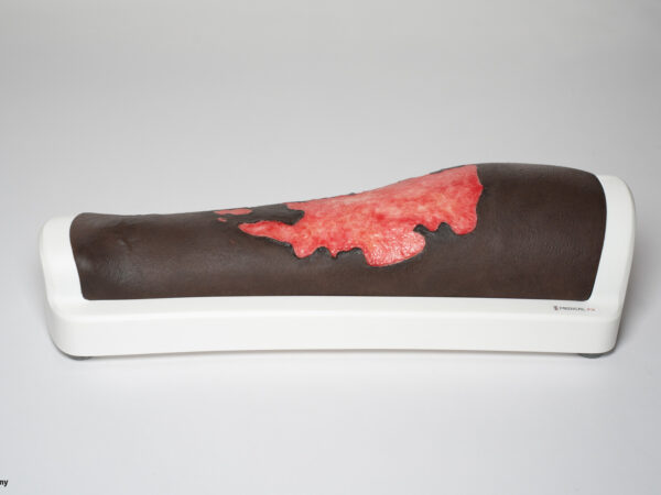 Rahmenmodell Bein mit Brandwunde Grad 3 – Bild 8