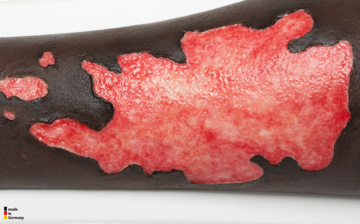 Rahmenmodell Bein mit Brandwunde Grad 3