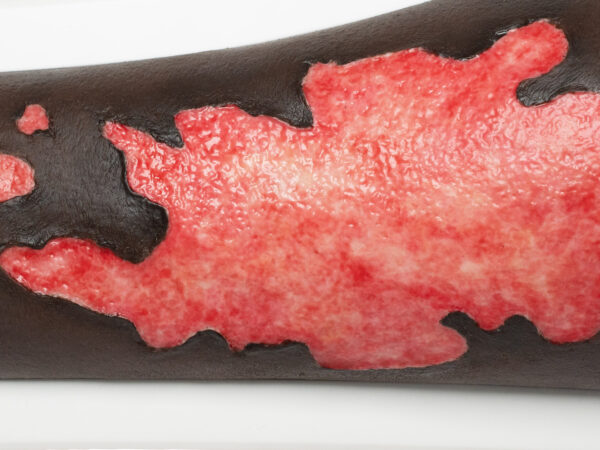 Rahmenmodell Bein mit Brandwunde Grad 3 – Bild 9