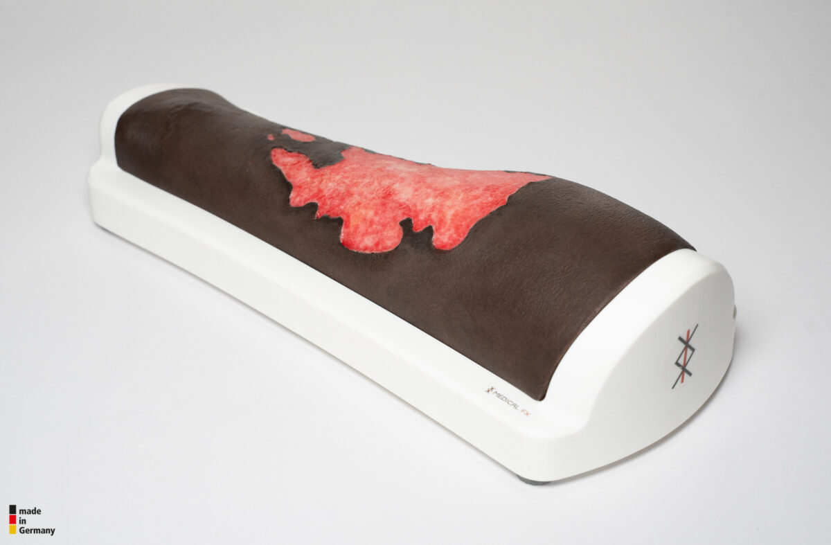 Rahmenmodell Bein mit Brandwunde Grad 3