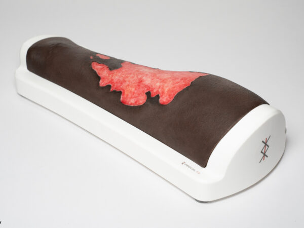 Rahmenmodell Bein mit Brandwunde Grad 3 – Bild 10