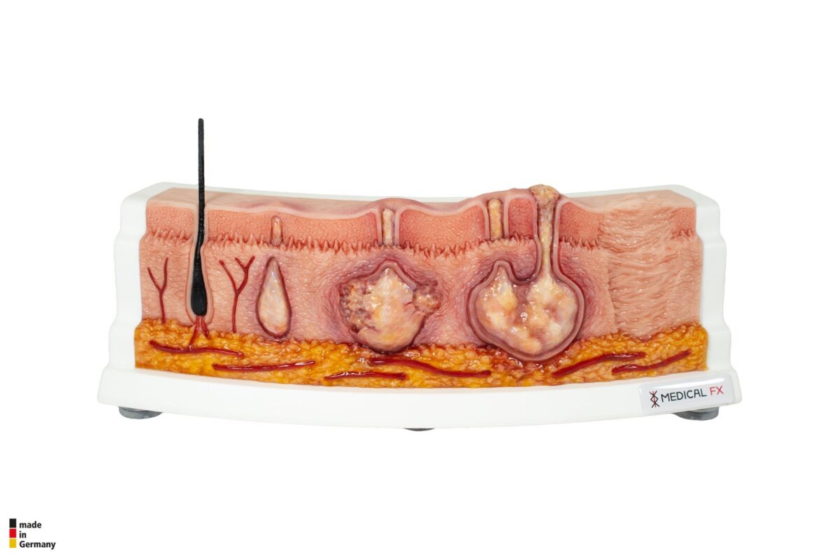 Rahmenmodell Hidradenitis Suppurativa (gebogener Querschnitt)