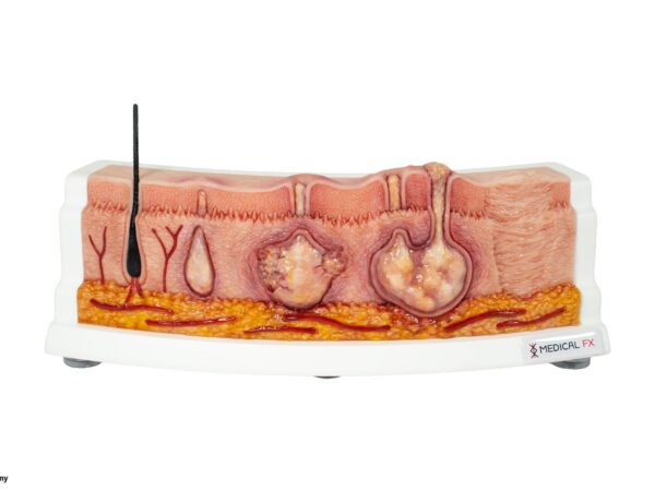 Rahmenmodell Hidradenitis Suppurativa (gebogener Querschnitt)