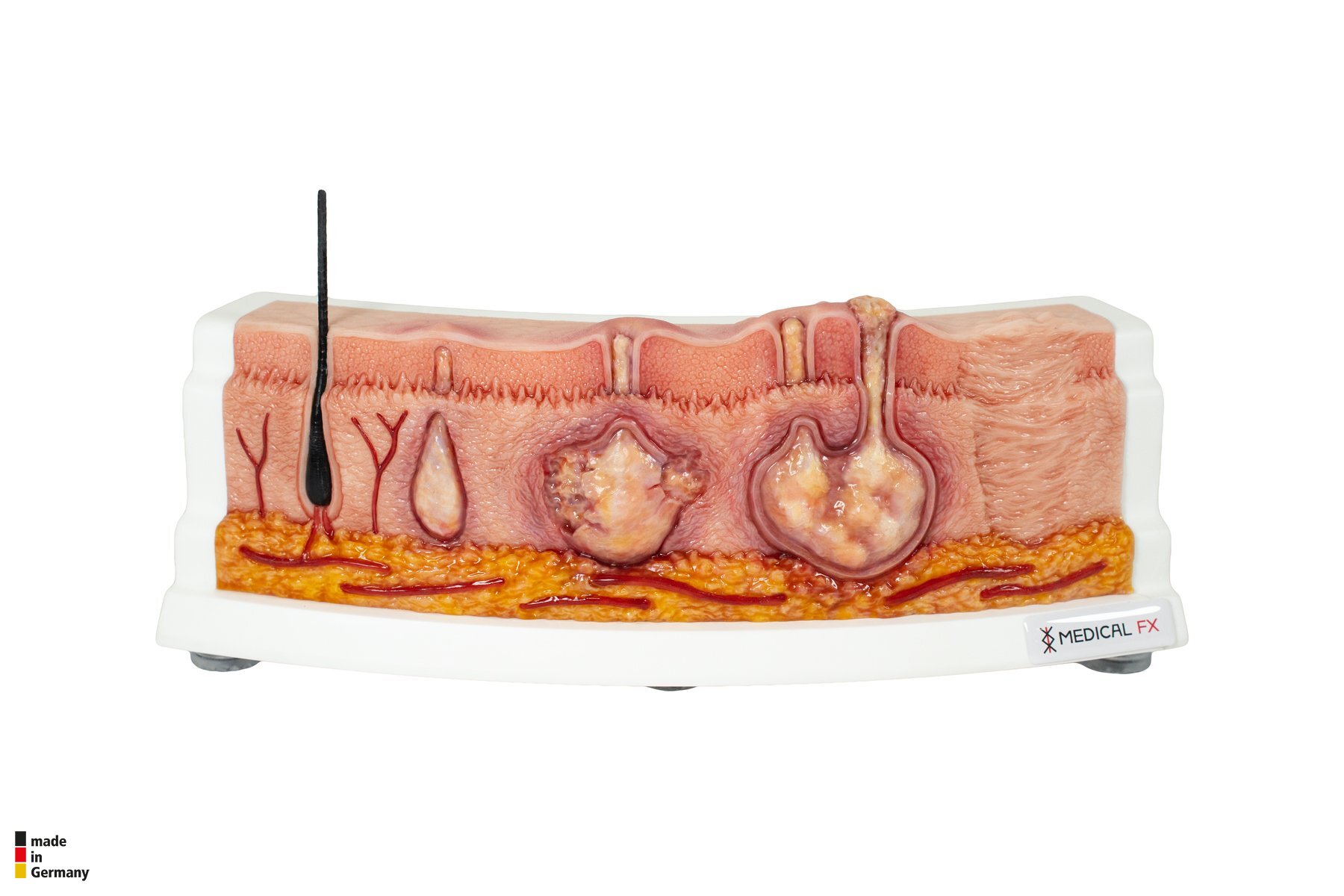 Rahmenmodell Hidradenitis Suppurativa (gebogener Querschnitt) – Bild 1