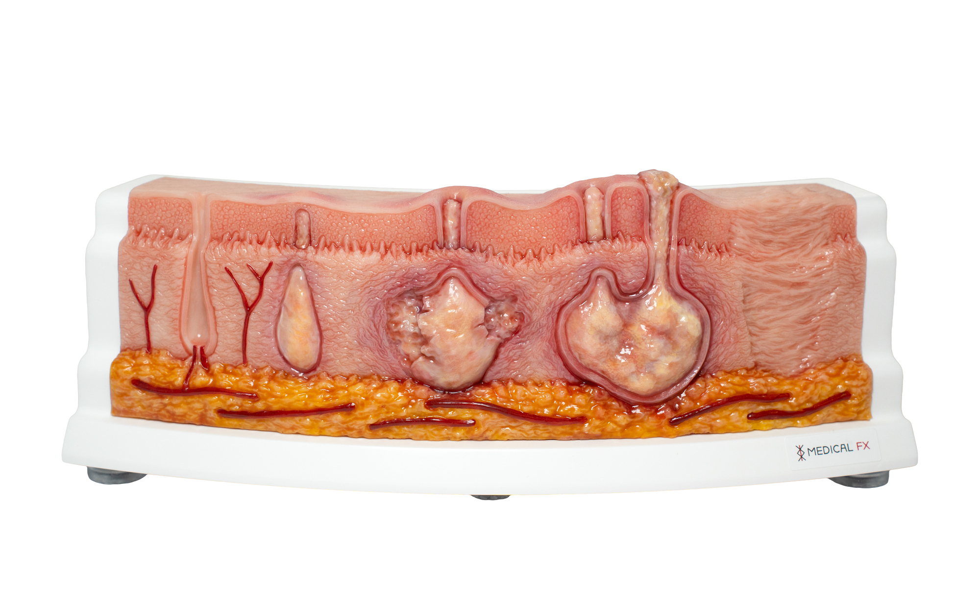 Rahmenmodell Hidradenitis Suppurativa (gebogener Querschnitt) – Bild 1