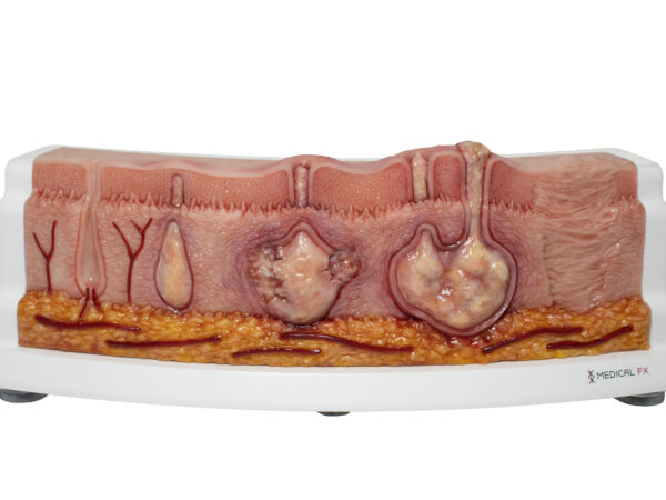 Frame Model Hidradenitis Suppurativa (Curved Cross-Section)