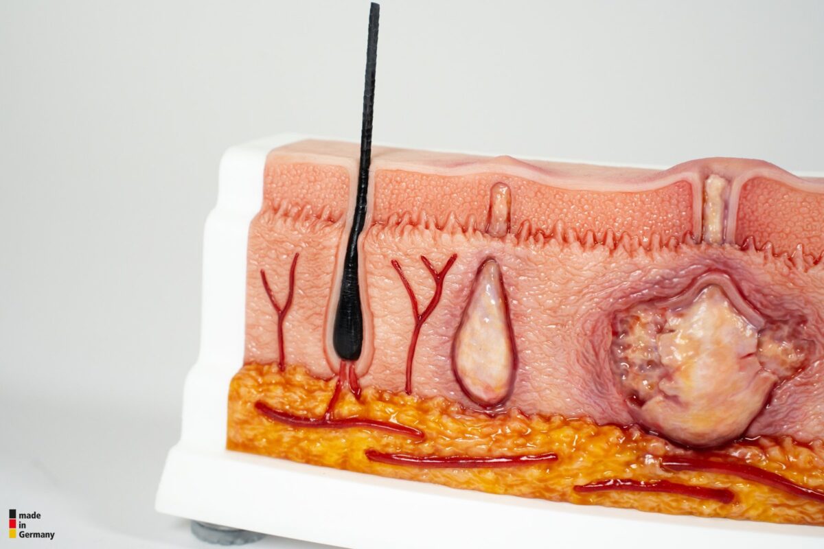 Rahmenmodell Hidradenitis Suppurativa (gebogener Querschnitt)
