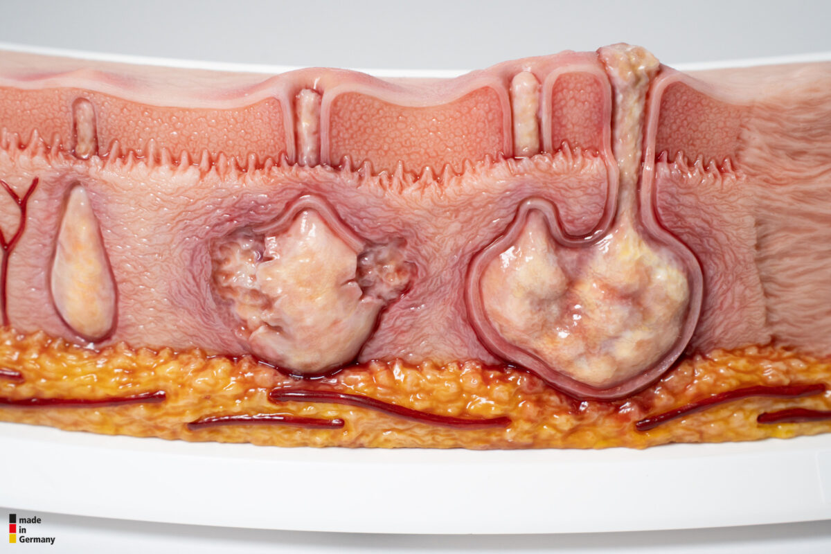 Rahmenmodell Hidradenitis Suppurativa (gebogener Querschnitt)