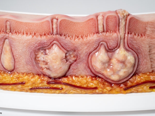 Rahmenmodell Hidradenitis Suppurativa (gebogener Querschnitt) – Bild 3