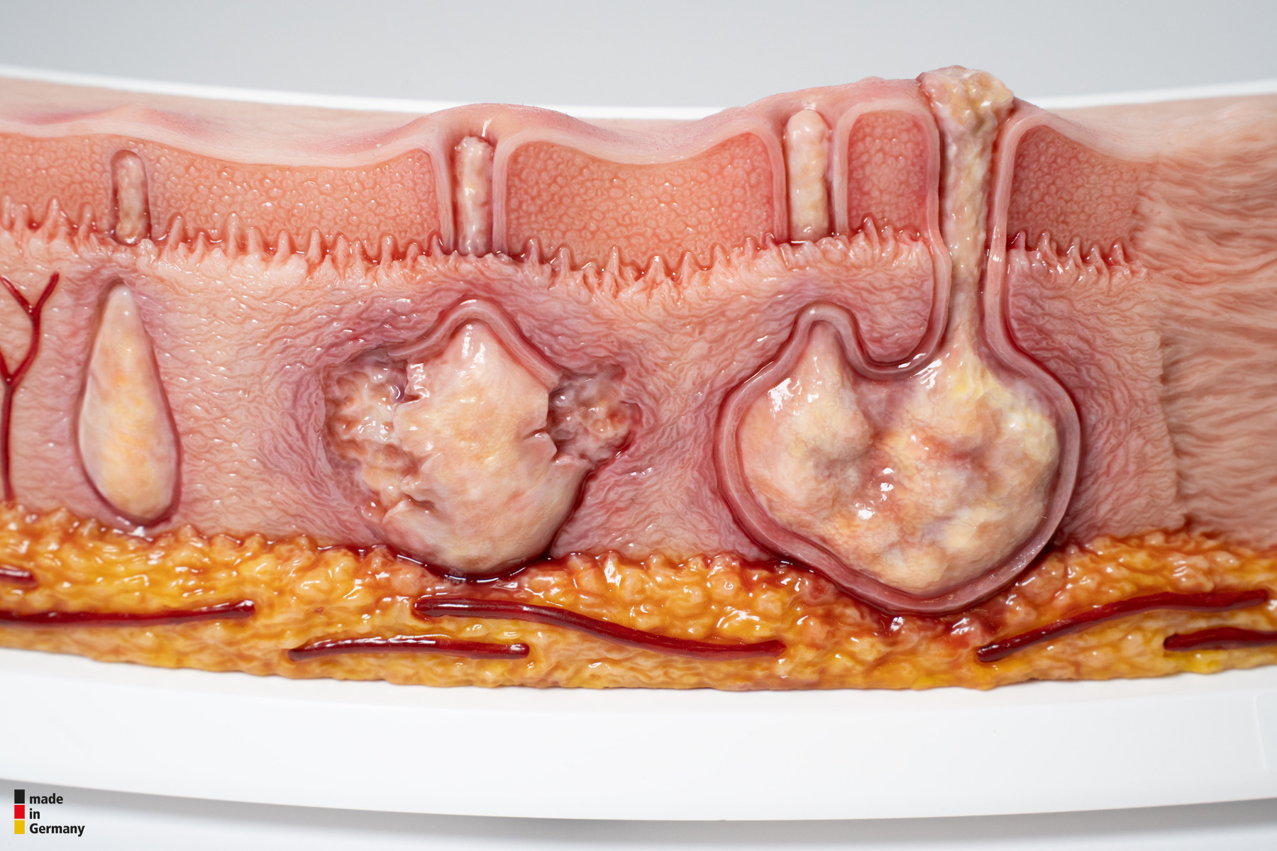 Rahmenmodell Hidradenitis Suppurativa (gebogener Querschnitt) – Bild 3