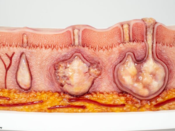Rahmenmodell Hidradenitis Suppurativa (gebogener Querschnitt) – Bild 3
